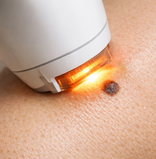 IPLはほくろが危険な理由